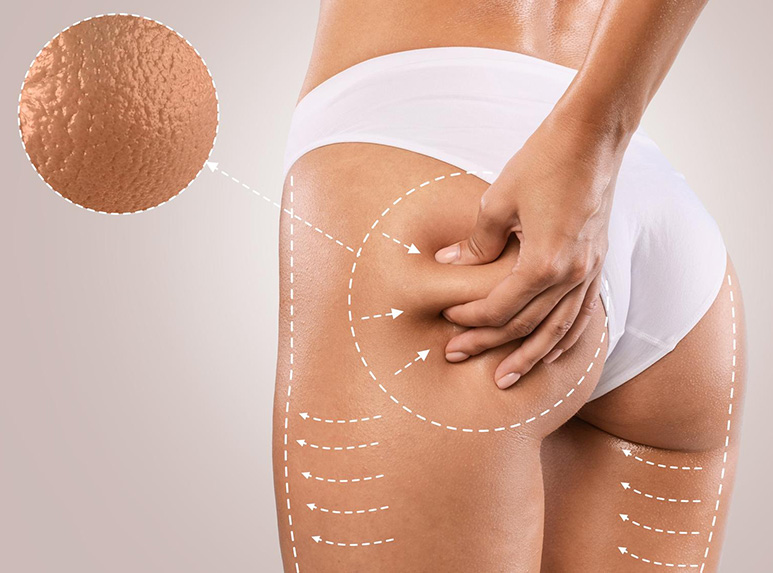Cellulite edematosa