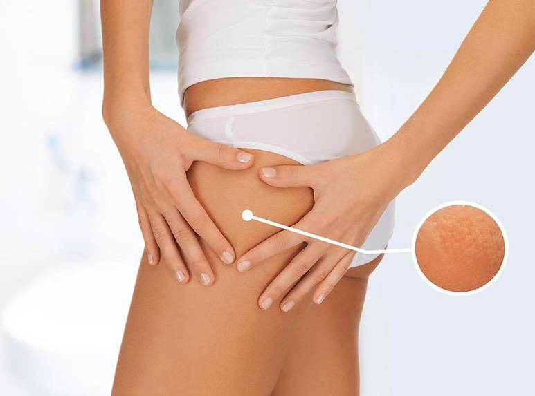 Cellulite e ritenzione idrica: scopriamo la differenza Cellulite e ritenzione idrica: scopriamo la differenza