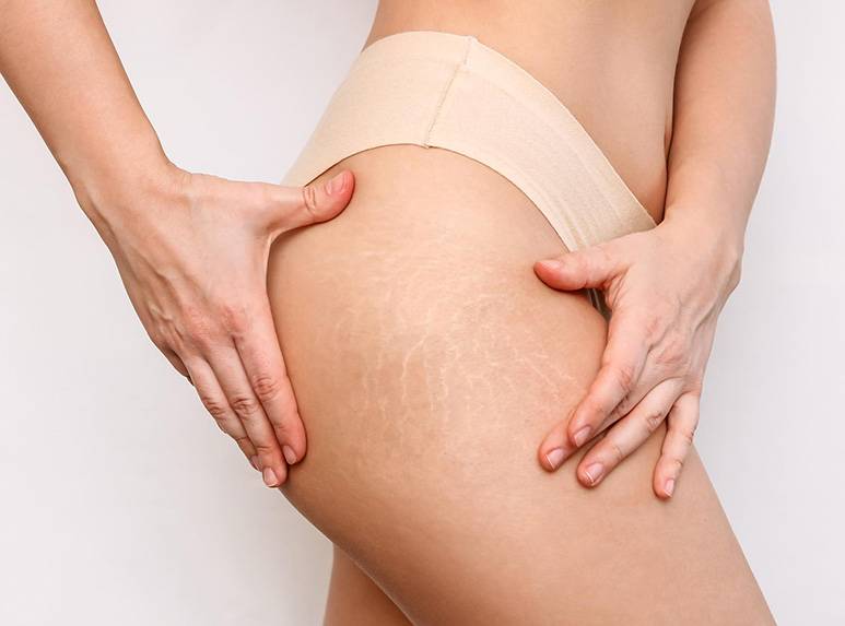 Cellulite e ritenzione idrica: scopriamo la differenza Cellulite e ritenzione idrica: scopriamo la differenza