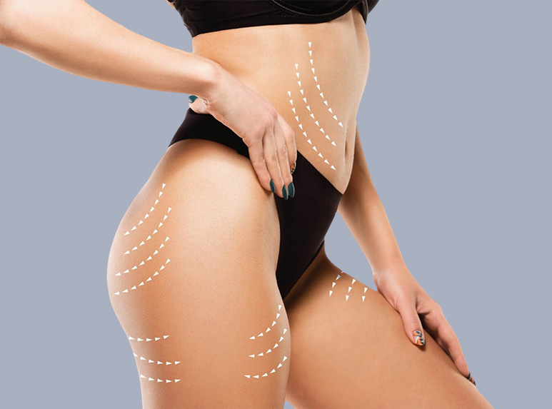 Cellulite sclerotica